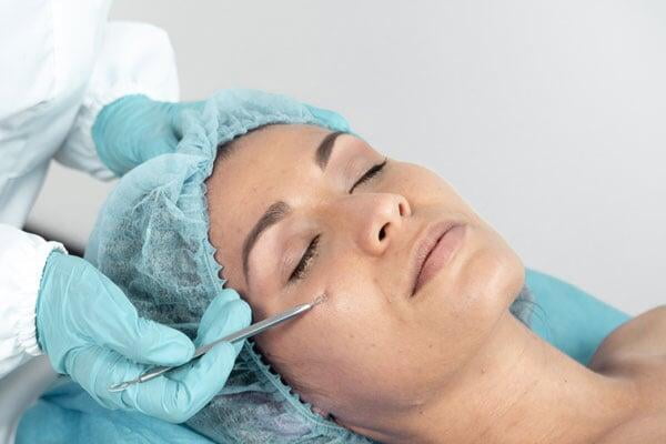 Tratamiento Anti Acné - Tratamiento facial en Reus