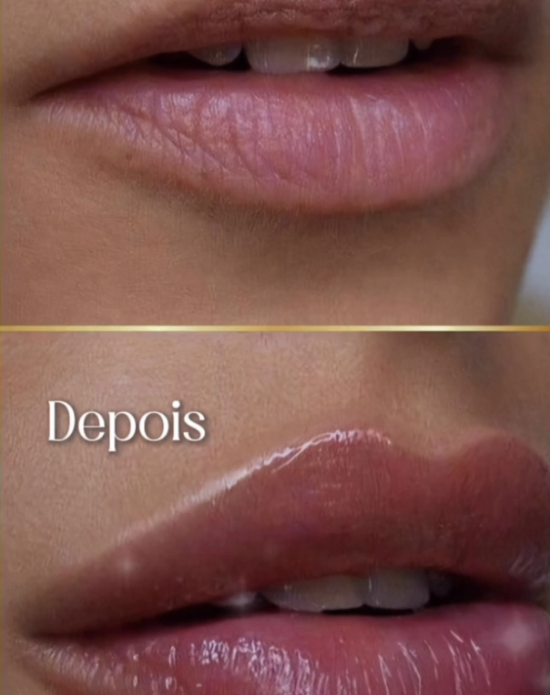 Tratamiento de labios antes y después